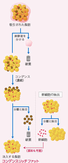 コンデンスリッチ豊胸・コンデンスリッチファット抽出